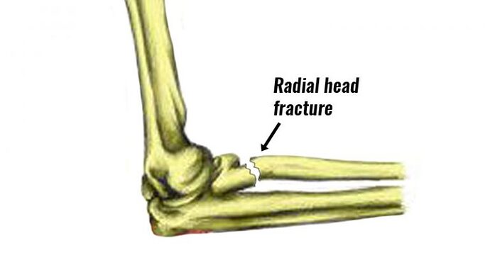 radial-head-fracture800-768x409-3705520693