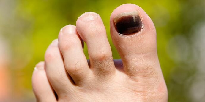 toe