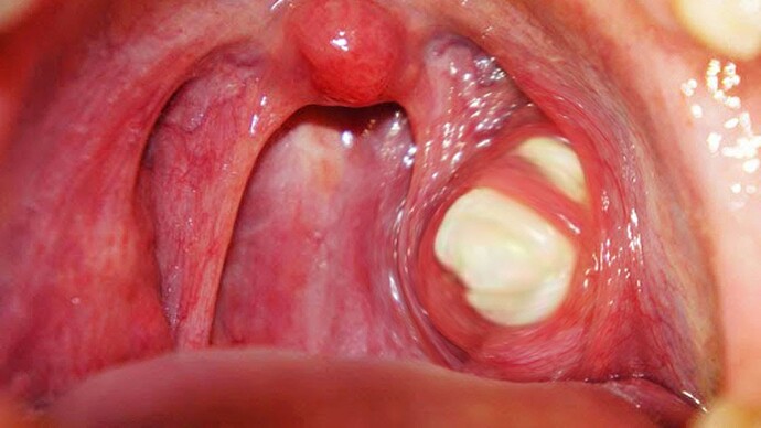 tonsil-stones