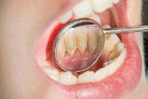 How-to-prevent-and-remove-tartarcalculus-plaque-from-teeth-min